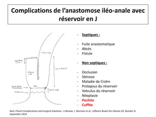 Complications de l’anastomose iléo-anale avec
réservoir en J
- Septiques :
- Fuite anastomotique
- Abcès
- Fistule
- Non septiques :
- Occlusion
- Sténose
- Maladie de Crohn
- Prolapsus du réservoir
- Volvulus du réservoir
- Néoplasie
- Pochite
- Cuffite
Ileal J Pouch Complications and Surgical Solutions : a Review, J. Sherman et al., Inflamm Bowel Dis Volume 20, Number 9,
September 2014
 