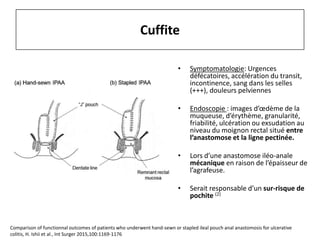 • Symptomatologie: Urgences
défécatoires, accélération du transit,
incontinence, sang dans les selles
(+++), douleurs pelviennes
• Endoscopie : images d’œdème de la
muqueuse, d’érythème, granularité,
friabilité, ulcération ou exsudation au
niveau du moignon rectal situé entre
l’anastomose et la ligne pectinée.
• Lors d’une anastomose iléo-anale
mécanique en raison de l’épaisseur de
l’agrafeuse.
• Serait responsable d’un sur-risque de
pochite (2)
Cuffite
Comparison of functionnal outcomes of patients who underwent hand-sewn or stapled ileal pouch anal anastomosis for ulcerative
colitis, H. Ishii et al., Int Surger 2015,100:1169-1176
 