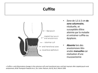 • Zone de 1,5 à 2 cm de
zone columnaire,
résiduelle, et
susceptible d’être
atteinte par la maladie
et entrainer cuffite ou
dysplasie.
• Absente lors des
anastomoses iléo-
anales manuelles car
réalisation d’une
mucosectomie
Cuffite
« Cuffitis » and inflammatory changes in the columnar cuff, anal transitional zone, and ileal reservoir after stapled pouch-anal
anastomosis, M.W Thompson-Fawcett et al., Dis. Colon. Rectum, Vol 42, No.3, March 1999
 