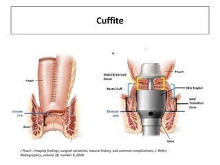 Cuffite
J Pouch : Imaging findings, surgical variations, natural history, and common complications, J. Reber,
Radiographics, volume 38, number 4, 2018
 