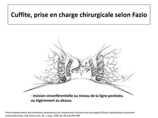 Cuffite, prise en charge chirurgicale selon Fazio
- Incision circonférentielle au niveau de la ligne pectinée,
ou légèrement au dessus
Pouch advancement and neoileonal anastomosis for anastomotic stricture and anovaginal fistula complicating restorative
proctocolectomy, V.W. Fazio et al., Br. J. Surg. 1992 Vol 79 July 694-696
 
