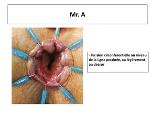 Mr. A
- Incision circonférentielle au niveau
de la ligne pectinée, ou légèrement
au dessus
 