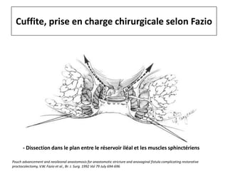 Cuffite, prise en charge chirurgicale selon Fazio
- Dissection dans le plan entre le réservoir iléal et les muscles sphinctériens
Pouch advancement and neoileonal anastomosis for anastomotic stricture and anovaginal fistula complicating restorative
proctocolectomy, V.W. Fazio et al., Br. J. Surg. 1992 Vol 79 July 694-696
 