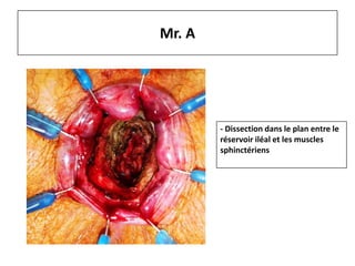 Mr. A
- Dissection dans le plan entre le
réservoir iléal et les muscles
sphinctériens
 
