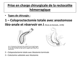 Prise en charge chirurgicale de la rectocolite
hémorragique
• Types de chirurgie :
1 – Coloproctectomie totale avec anastomose
iléo-anale et réservoir en J (Parks & Nicholls, 1978)
2 – Coloproctectomie totale avec iléostomie terminale
3 – Colectomie subtotale avec iléostomie
 