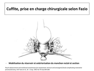 Cuffite, prise en charge chirurgicale selon Fazio
- Mobilisation du réservoir et extériorisation du manchon rectal et section
Pouch advancement and neoileonal anastomosis for anastomotic stricture and anovaginal fistula complicating restorative
proctocolectomy, V.W. Fazio et al., Br. J. Surg. 1992 Vol 79 July 694-696
 