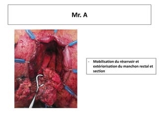 Mr. A
- Mobilisation du réservoir et
extériorisation du manchon rectal et
section
 