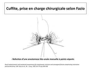 Cuffite, prise en charge chirurgicale selon Fazio
- Refection d’une anastomose iléo-anale manuelle à points séparés
Pouch advancement and neoileonal anastomosis for anastomotic stricture and anovaginal fistula complicating restorative
proctocolectomy, V.W. Fazio et al., Br. J. Surg. 1992 Vol 79 July 694-696
 