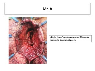 Mr. A
- Refection d’une anastomose iléo-anale
manuelle à points séparés
 