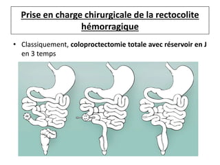 Prise en charge chirurgicale de la rectocolite
hémorragique
• Classiquement, coloproctectomie totale avec réservoir en J
en 3 temps
 