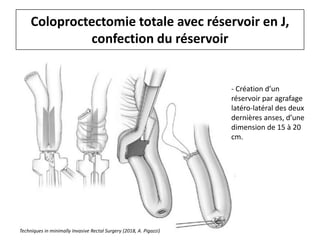 Coloproctectomie totale avec réservoir en J,
confection du réservoir
- Création d’un
réservoir par agrafage
latéro-latéral des deux
dernières anses, d’une
dimension de 15 à 20
cm.
Techniques in minimally Invasive Rectal Surgery (2018, A. Pigazzi)
 