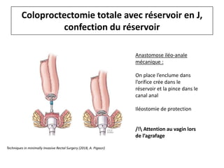 Coloproctectomie totale avec réservoir en J,
confection du réservoir
Anastomose iléo-anale
mécanique :
On place l’enclume dans
l’orifice crée dans le
réservoir et la pince dans le
canal anal
Iléostomie de protection
/! Attention au vagin lors
de l’agrafage
Techniques in minimally Invasive Rectal Surgery (2018, A. Pigazzi)
 