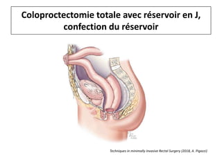 Coloproctectomie totale avec réservoir en J,
confection du réservoir
Techniques in minimally Invasive Rectal Surgery (2018, A. Pigazzi)
 
