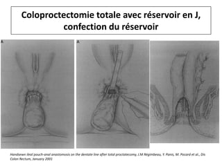 Coloproctectomie totale avec réservoir en J,
confection du réservoir
Handsewn ileal pouch-anal anastomosis on the dentate line after total proctatecomy, J.M Régimbeau, Y. Panis, M. Pocard et al., Dis
Colon Rectum, January 2001
 