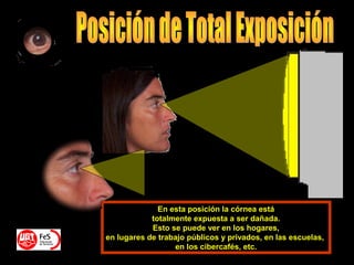 En esta posición la córnea está
totalmente expuesta a ser dañada.
Esto se puede ver en los hogares,
en lugares de trabajo públicos y privados, en las escuelas,
en los cibercafés, etc.
 