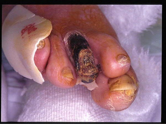 El hongo de las uñas la fase pesada
