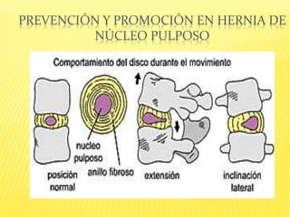 PREVENCIÓN Y PROMOCIÓN EN HERNIA DE
NÚCLEO PULPOSO
 