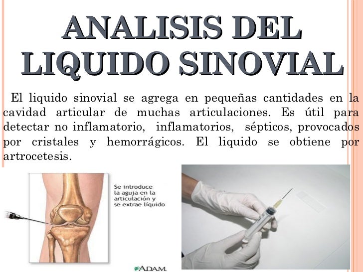 Quiste Subaracnoideo Pdf Quiste Subaracnoideo Pdf