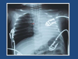 Cuidado del paciente con dispositivos invasivos respiratorios