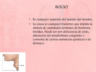 BOCIO

• Es cualquier aumento del tamaño del tiroides.
• La causa es cualquier trastorno que impida la
  síntesis de cantidades normales de hormona
  tiroidea. Puede ser por deficiencia de yodo,
  alteración del metabolismo congénito o
  consumo de ciertas sustancias químicas o de
  fármaco.
 