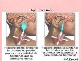 Hipotiroidismo
 