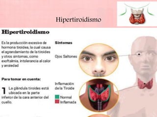 Hipertiroidismo
 