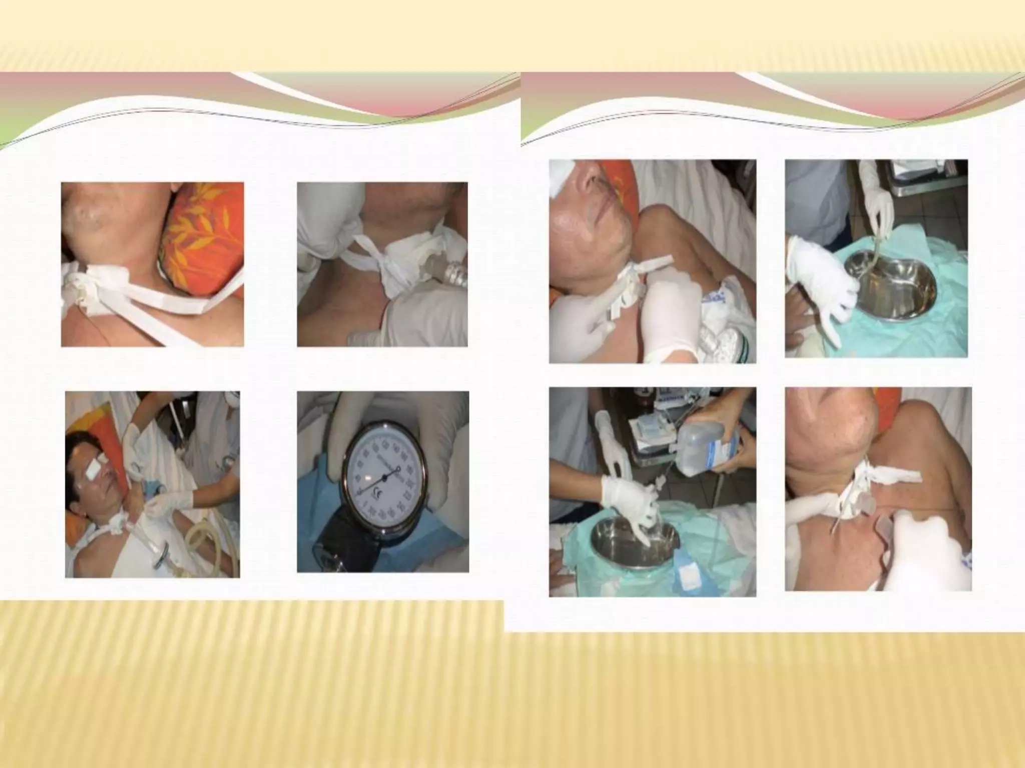 Cuidado de ostomias | PPT