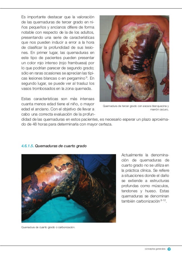 Cuidado de personas que sufren quemaduras Cuidado de personas que sufren quemaduras