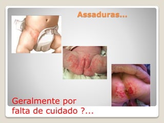 Assaduras...
Geralmente por
falta de cuidado ?...
 