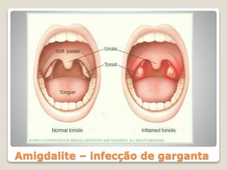 Amigdalite – infecção de garganta
 