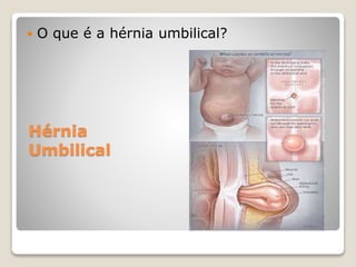 Hérnia
Umbilical
 O que é a hérnia umbilical?
 