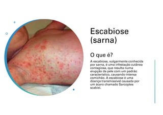 Escabiose
(sarna)
O que é?
A escabiose, vulgarmente conhecida
por sarna, é uma infestação cutânea
contagiosa, que resulta numa
erupção da pele com um padrão
característico, causando intensa
comichão. A escabiose é uma
doença transmissível causada por
um ácaro chamado Sarcoptes
scabiei.
 