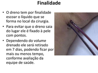 Finalidade
• O dreno tem por finalidade
escoar o líquido que se
forma no local da cirurgia.
• Para evitar que o dreno saia
do lugar ele é fixado à pele
com pontos.
• Dependendo do volume
drenado ele será retirado
em 7 dias, podendo ficar por
mais ou menos tempo,
conforme avaliação da
equipe de saúde.
 