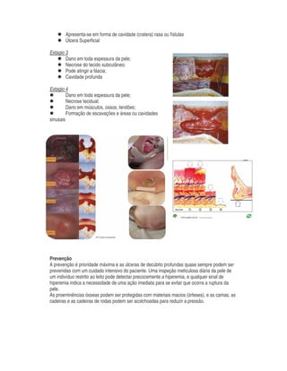 Apresenta-se em forma de cavidade (cratera) rasa ou fístulas
Úlcera Superficial
Estagio 3
Dano em toda espessura da pele;
Necrose do tecido subcutâneo;
Pode atingir a fáscia;
Cavidade profunda
Estagio 4
Dano em toda espessura da pele;
Necrose tecidual;
Dano em músculos, ossos, tendões;
Formação de escavações e áreas ou cavidades
sinusais
Prevenção
A prevenção é prioridade máxima e as úlceras de decúbito profundas quase sempre podem ser
prevenidas com um cuidado intensivo do paciente. Uma inspeção meticulosa diária da pele de
um indivíduo restrito ao leito pode detectar precocemente a hiperemia, e qualquer sinal de
hiperemia indica a necessidade de uma ação imediata para se evitar que ocorra a ruptura da
pele.
As proeminências ósseas podem ser protegidas com materiais macios (órteses), e as camas, as
cadeiras e as cadeiras de rodas podem ser acolchoadas para reduzir a pressão.
 