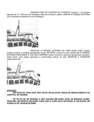 ASPIRAR COM UM CATETER DE PLÁSTICO (sonda n° 12) sempre
jogando de 5 a 10ml de soro fisiológico antes de introduzir cateter. LIMPAR A PORÇÃO EXTERNA
com contonete embebido em soro fisiológico.




                          ANGULAR A PORÇÃO EXTERNA DO TUBO PARA CIMA, aspirar
(neste momento o paciente apresentará tosse), RETIRAR a sonda do tubo, ANGULAR A PORÇÃO
EXTERNA PARA BAIXO E VOLTAR A ASPIRAR (neste momento o paciente apresentará náuseas),
desta forma você estará aspirando à extremidade interna do tubo INFERIOR E SUPERIOR
respectivamente.




ATENÇÃO:
     -EM CASO DO TUBO SAIR, NÃO TENTE RECOLOCAR, DIRIJA-SE IMEDIATAMENTE AO
HOSPITAL DE ORIGEM.

    -SE FALTA DE AR INTENSA E NÃO HOUVER MELHORA APÓS AS MEDIDAS ACIMA,
PROCURE UM PRONTO SOCORRO PARA QUE O TUBO SEJA RETIRADO E COLOCADA UM
ACÂNULA DE TRAQUEOSTOMIA.
 