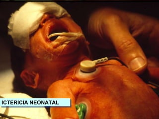 ICTERICIA NEONATAL 