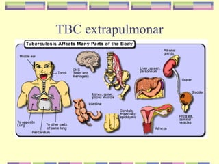 TBC extrapulmonar
 