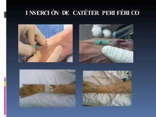 INSERCIÓN DE CATÉTER PERIFÉRICO 