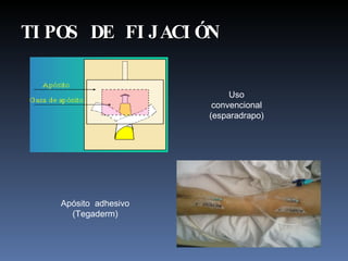 TIPOS DE FIJACIÓN Apósito  adhesivo (Tegaderm) Uso convencional (esparadrapo) 