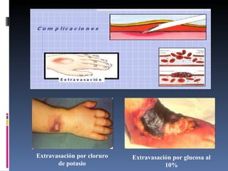 Extravasación por cloruro de potasio Extravasación por glucosa al 10% 