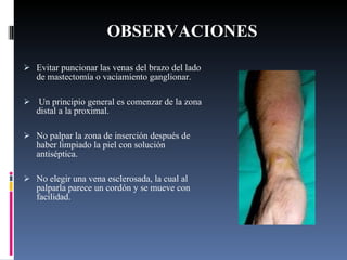 OBSERVACIONES Evitar puncionar las venas del brazo del lado de mastectomía o vaciamiento ganglionar.   Un principio general es comenzar de la zona distal a la proximal. No palpar la zona de inserción después de haber limpiado la piel con solución antiséptica.   No elegir una vena esclerosada, la cual al palparla parece un cordón y se mueve con facilidad.   