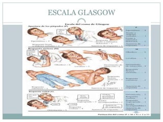 ESCALA GLASGOW
 