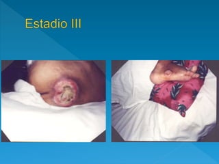 ESTADIO III y IV
SIN INFECCIÓN LOCAL
Desinfección de piel circundante
Lavado con solución salina
Desbridación enzimátic...
