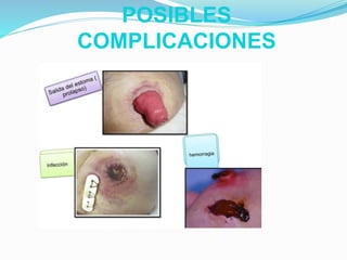 POSIBLES
COMPLICACIONES
 