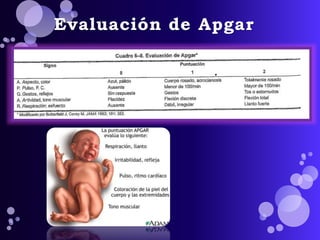 Evaluación de Apgar 
 