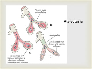 Atelectasia
 