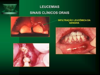 LEUCEMIAS
SINAIS CLÍNICOS ORAIS
INFILTRAÇÃO LEUCÊMICA DA
GENGIVA
 