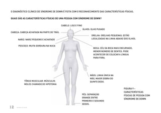O DIAGNÓSTICO CLÍNICO DE SÍNDROME DE DOWN É FEITA COM O RECONHECIMENTO DAS CARACTERÍSTICAS FÍSICAS.


          QUAIS SÃO AS CARACTERÍSTICAS FÍSICAS DE UMA PESSOA COM SÍNDROME DE DOWN?


                                                                CABELO: LISO E FINO
                                                                                      OLHOS: OLHO PUXADO
          CABEÇA: CABEÇA ACHATADA NA PARTE DE TRÁS.
                                                                                             ORELHA: ORELHAS PEQUENAS. ESTÃO
                        NARIZ: NARIZ PEQUENO E ACHATADO                                      LOCALIZADAS NA LINHA ABAIXO DOS OLHOS.


                         PESCOÇO: MUITA GORDURA NA NUCA
                                                                                              BOCA: CÉU DA BOCA MAIS ENCURVADO,
                                                                                              MENOR NÚMERO DE DENTES. PODE
                                                                                              ACONTECER DE COLOCAR A LÍNGUA
                                                                                              PARA FORA.




                                                                                            MÃOS: LINHA ÚNICA NA
                                                                                            MÃO, MAIOR DOBRA DO
                                   TÔNUS MUSCULAR: MÚSCULOS                                 QUINTO DEDO.
                                   MOLES CHAMADO DE HIPOTONIA

                                                                                                                            FIGURA 9 –
                                                                                                                            CARACTERÍSTICAS
                                                                                  PÉS: SEPARAÇÃO                            FÍSICAS DE PESSOA COM
                                                                                  GRANDE ENTRE
                                                                                                                            SÍNDROME DE DOWN
                                                                                  PRIMEIRO E SEGUNDO
                                                                                  DEDOS.
       12
Ministério da Saúde
                      Ministério da Saúde
                                                                                                                    CUIDADOS DE SAÚDE ÀS PESSOAS COM SÍNDROME DE DOWN
                                                                                                                                                                        12
 
