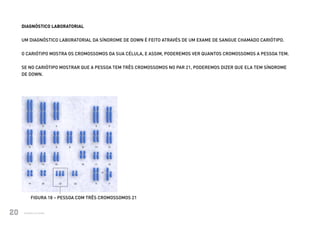 DIAGNÓSTICO LABORATORIAL


          UM DIAGNÓSTICO LABORATORIAL DA SÍNDROME DE DOWN É FEITO ATRAVÉS DE UM EXAME DE SANGUE CHAMADO CARIÓTIPO.


          O CARIÓTIPO MOSTRA OS CROMOSSOMOS DA SUA CÉLULA, E ASSIM, PODEREMOS VER QUANTOS CROMOSSOMOS A PESSOA TEM.


          SE NO CARIÓTIPO MOSTRAR QUE A PESSOA TEM TRÊS CROMOSSOMOS NO PAR 21, PODEREMOS DIZER QUE ELA TEM SÍNDROME
          DE DOWN.




                   FIGURA 18 – PESSOA COM TRÊS CROMOSSOMOS 21


20
                                                                                                                                                  20
              Ministério da Saúde
Ministério da Saúde                                                                           CUIDADOS DE SAÚDE ÀS PESSOAS COM SÍNDROME DE DOWN
 