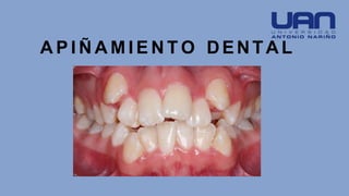 A P I Ñ A M I E N T O DENTAL
 